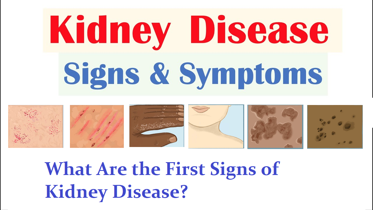 Kidney Disease