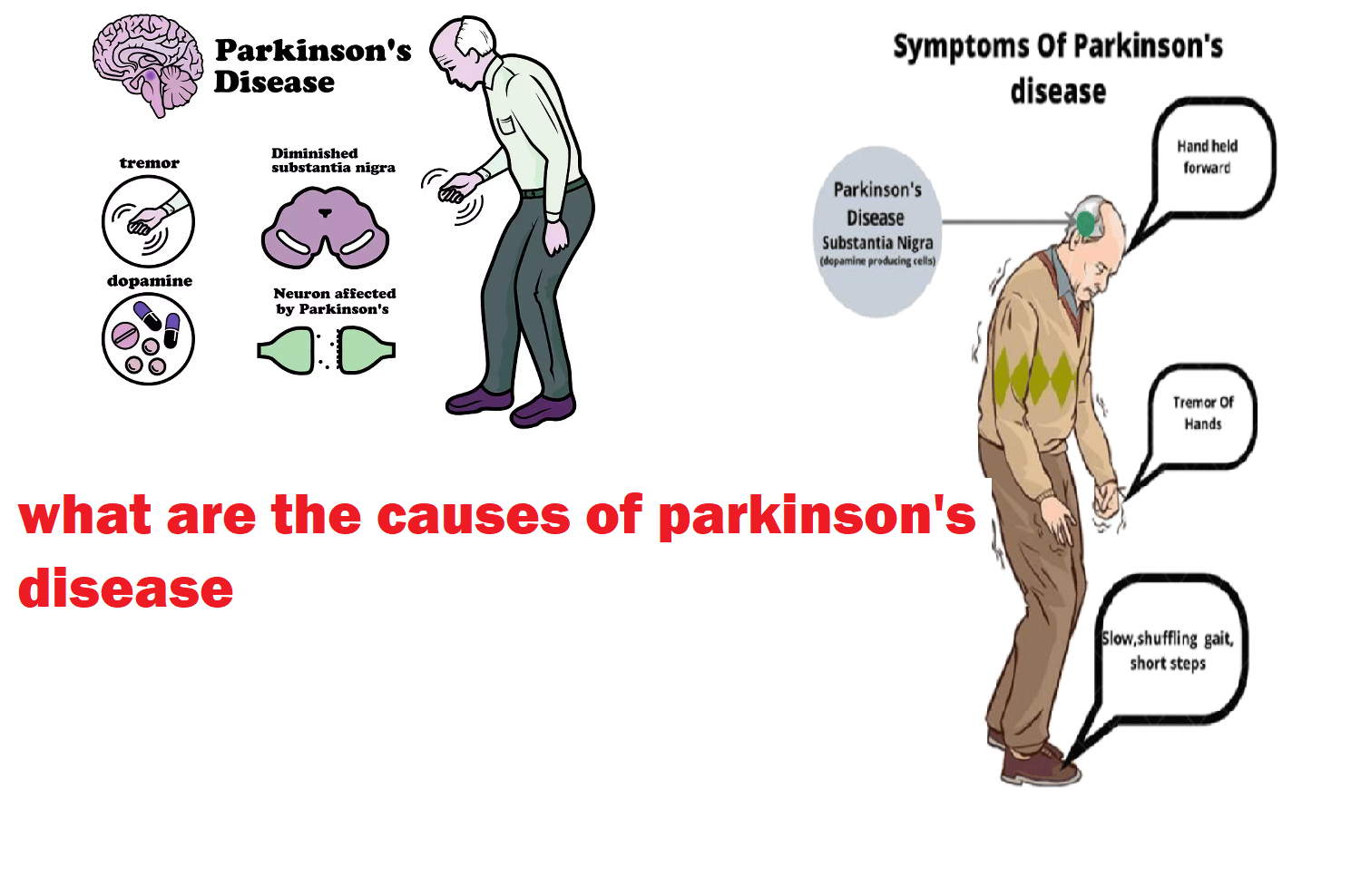 parkinson's disease