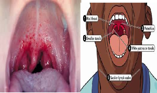 symptoms of strep throat